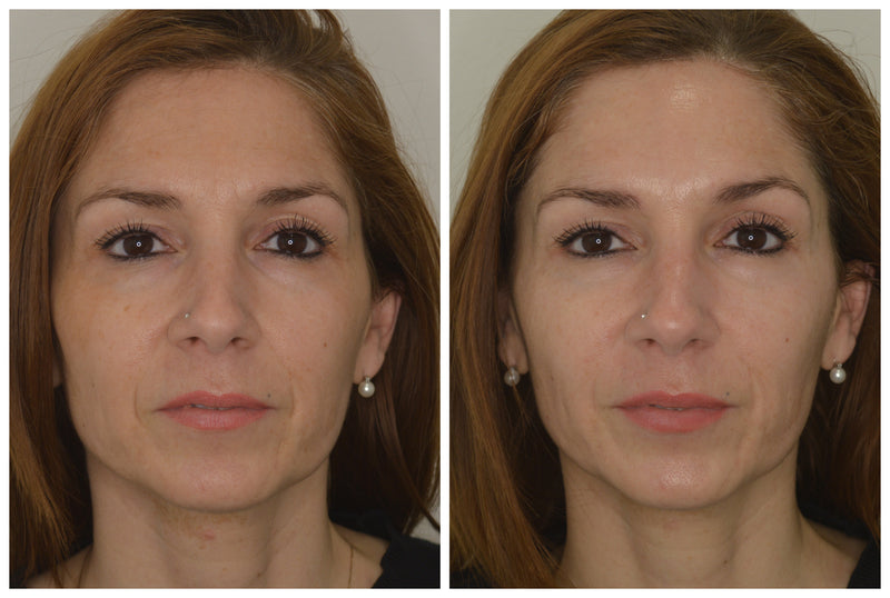 AGELESS Total Pure hyaluronic filler