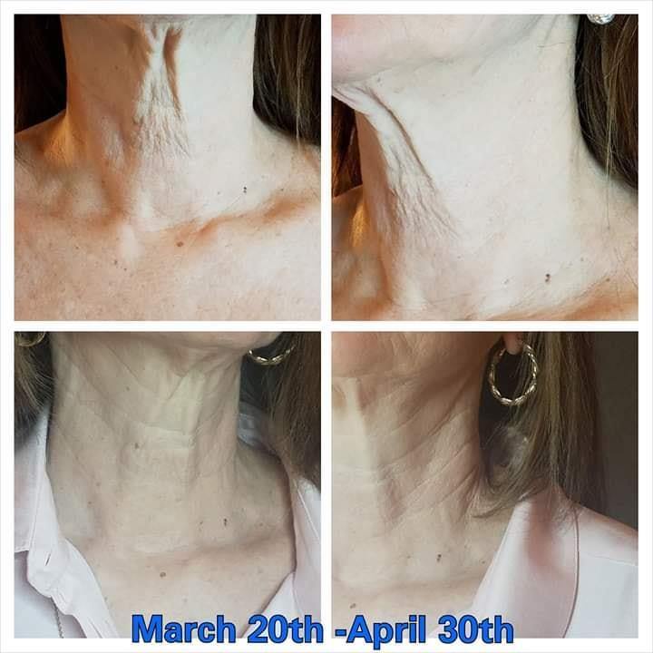 THE MAX STEM CELL NECK LIFT - Beautyzon