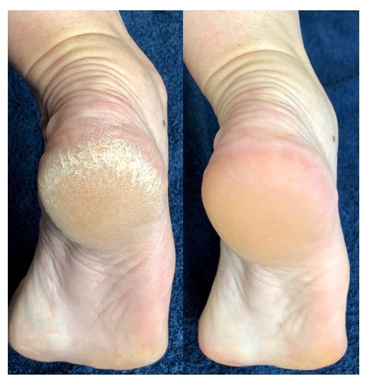 LOVASKIN - instant foot peeling KIT - Beautyzon